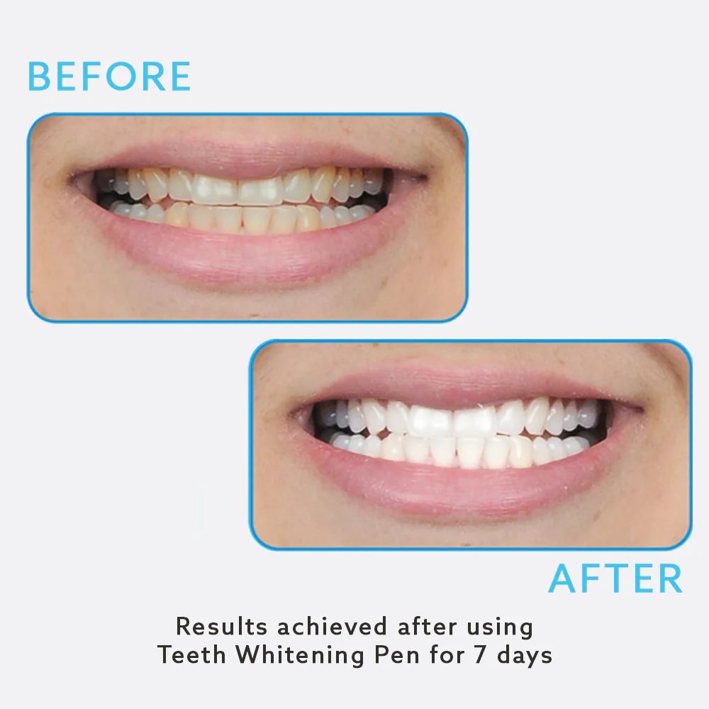 Top 10 Teeth Whitening Kits for 2024 — photo 26 Top 10 Teeth Whitening Kits for 2024 — photo 26