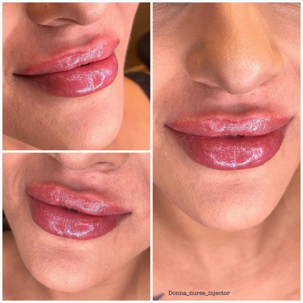 HA Dermal Filler Injection HA Dermal Filler Injection